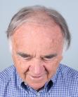 Before Hair Transplant&nbsp;Front